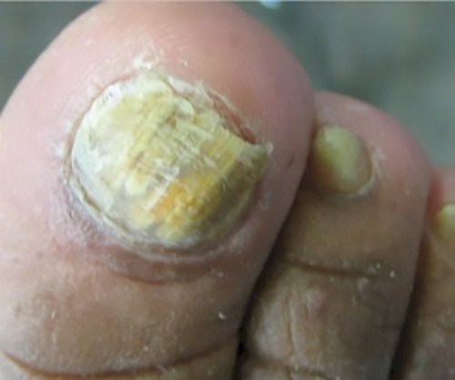Onychomycosis | Causes and treatment options | MyFootShop.com