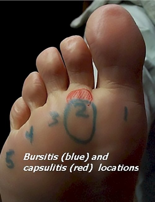 Bursitis of the Forefoot and Heel Causes and treatment options