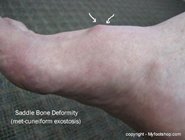 Saddle bone deformity