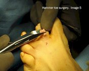 Hammer_toe_surgery_image5