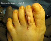 Hammer_toe_surgery_image6