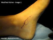 modified_Kidner_surgery