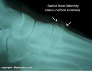 Saddle_bone_deformity_x-ray