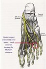 Anatomy_Morton's_neuroma