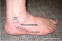 peroneal_tendonitis