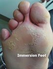 Immersion foot