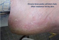 fungal infection of the foot