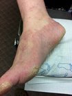 chronic fungal infection foot