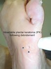 intractable plantar keratoma (IPK)