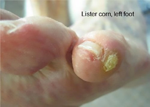 corn on inside of pinky toe