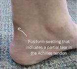 Achilles_tendon_rupture