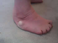 adult_clubfoot_post_surgical_correction