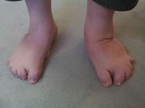 Clubfeet | Causes and treatment options 
