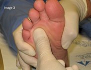 Muldier's_sign_Morton's_neuroma_image3