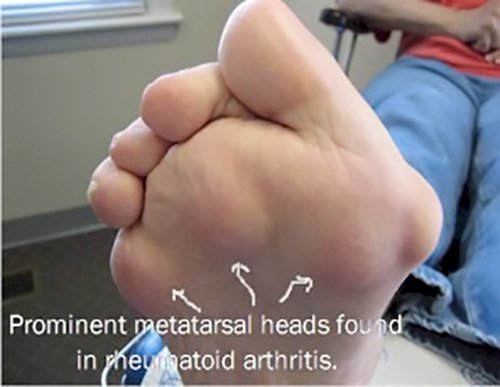 metatarsalis arthrosis)