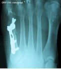 Metatarsal_fracture_x-ray_post-op