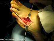 Metatarsal_fracture_surgery_image2
