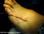 Metatarsal_fracture_surgery_image4
