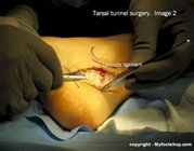 Tarsal tunnel release surgery