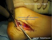 diabetic_peripheral_nerve_surgery_posterior_tibial_nerve