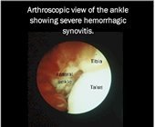 arthroscopic_ankle_surgery