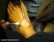 diabetic_peripheral_nerve_surgery_deep_peroneal_nerve