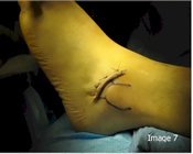 Brostrom_lateral_ankle_stabilization_surgery