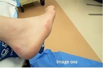 Charcot_joint_surgery_image1