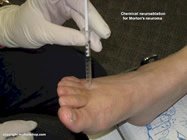 chemical_ablation_of_Morton's_neuroma