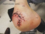diabetic_amputation_of_the_foot