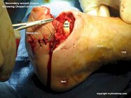 diabetic_amputation_of_the_foot