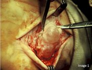 Ganglionic_cyst_surgery_image1