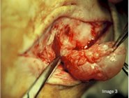 Ganglionic_cyst_surgery_image3
