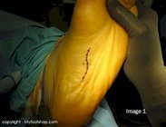 Glomus_tumor_surgery_image1