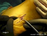 Glomus_tumor_surgery_image3