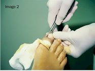 Ingrown_toe_nail_surgery_image2