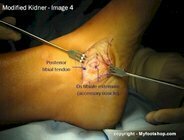 Modified Kidner procedure