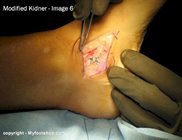 Modified Kidner procedure