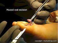 Mucoid_cyst_surgery