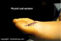 Mucoid_cyst_surgery