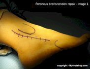 Surgical repair of the peroneus brevis