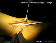 Peroneal tendon repair