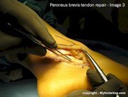 Peroneus brevis tendon repair