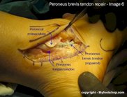 Peroneal_tendon_subluxation