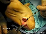 plantar_fibromatosis_surgery
