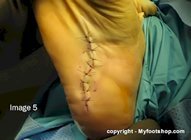 plantar_fibromatosis_surgery