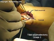 tibial_sesamoid_fracture_surgery