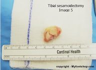 sesamoid_surgery