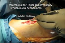 Topaz_surgery