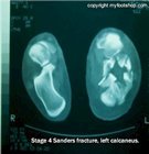 calcaneal fracture CT scan